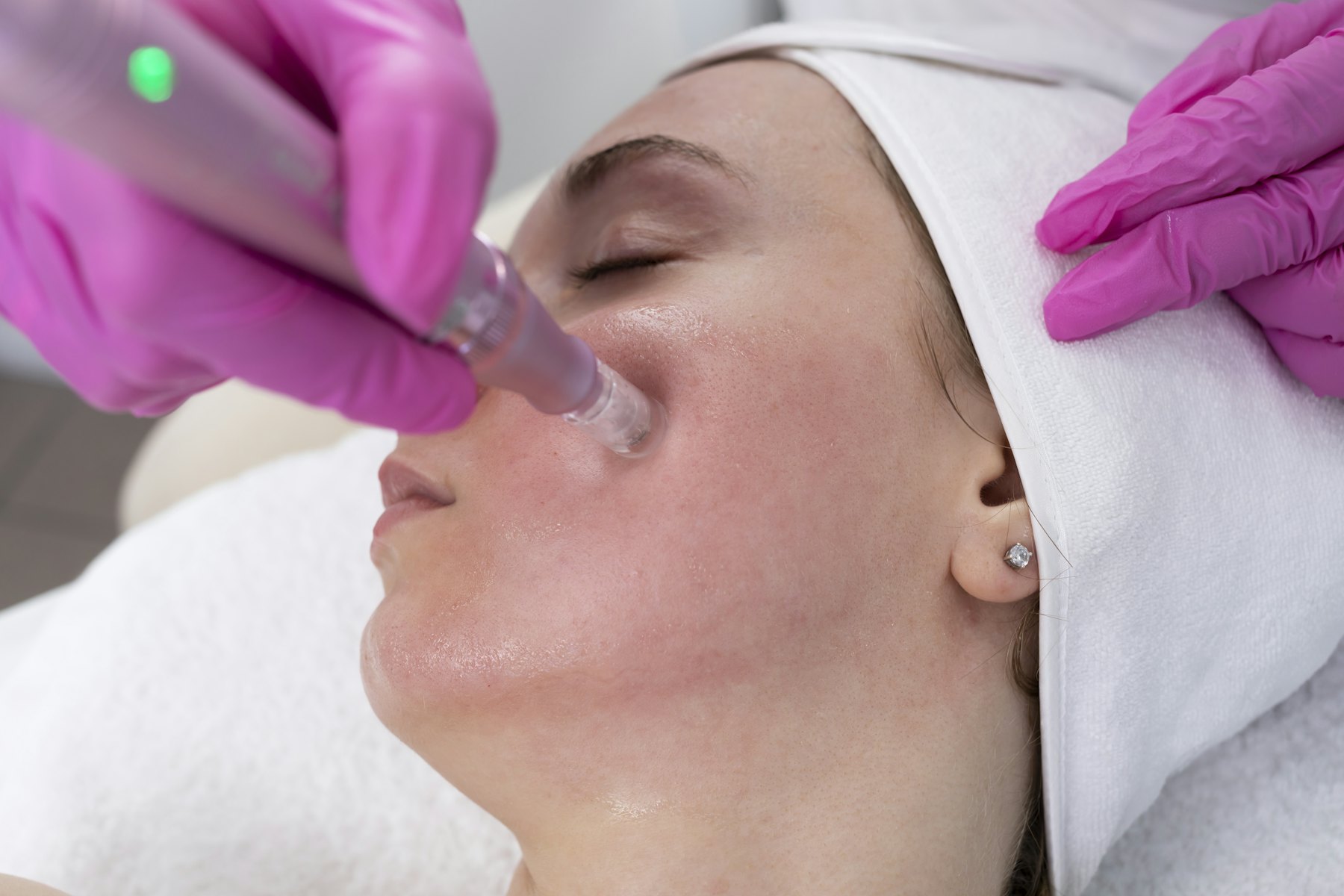 A microneedling pen being used on a client’s cheek